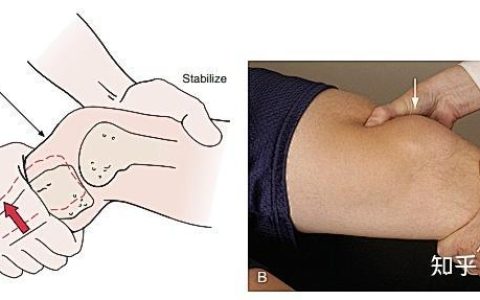 膝关节拨号试验：检查膝关节稳定性的重要方法
